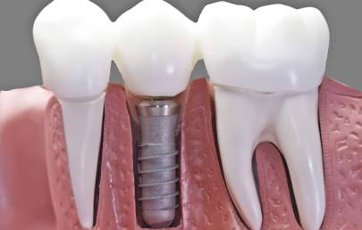 Dental Implant setup