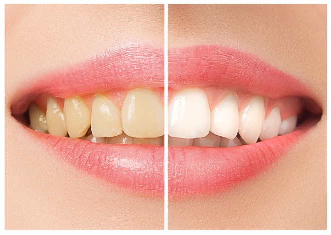 Teeth Whitening Treatment in Kondhwa - Dr Kotadia